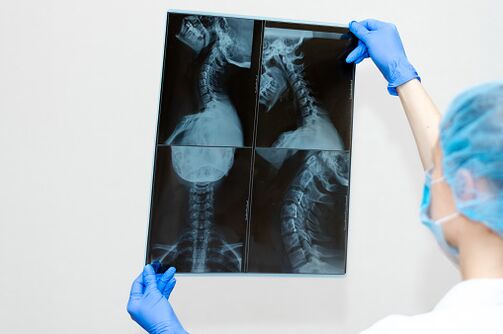 Osteocondrosis Enfermedad espinal