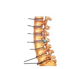 etapas de desarrollo de la osteocondrosis