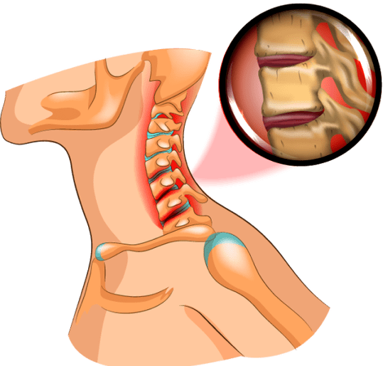 osteocondrosis en el cuello