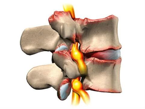 Lesiones espinales debido a la osteocondrosis.