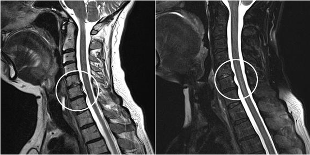 osteocondrosis cervical en radiografía