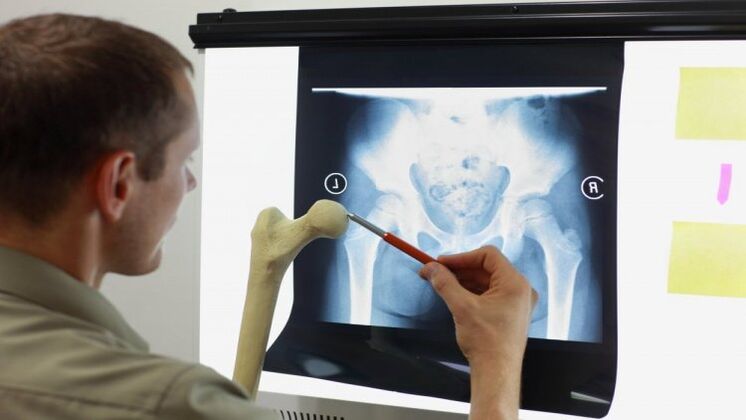 El médico examina una radiografía para detectar artrosis de cadera.