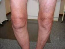 Síntomas de artrosis de la articulación de la rodilla.